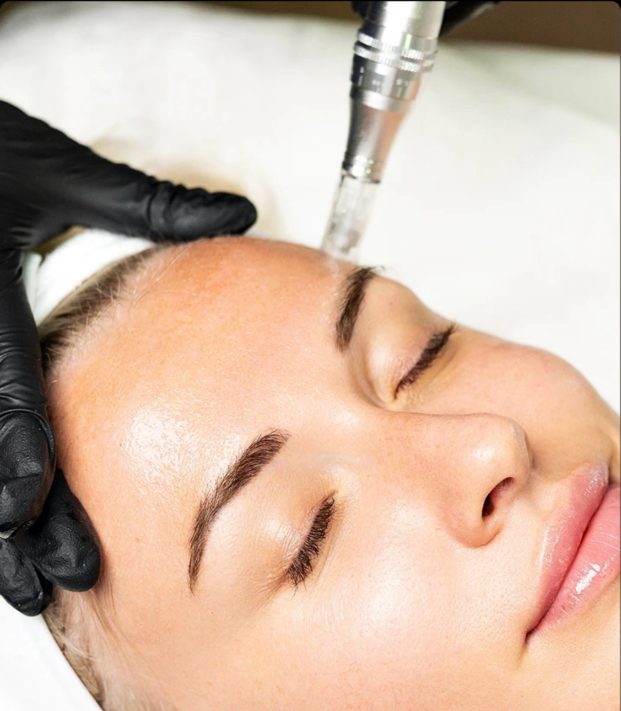 Skin Needling at Luxx Beauty Hair & Esthetics in Pflugerville, TX