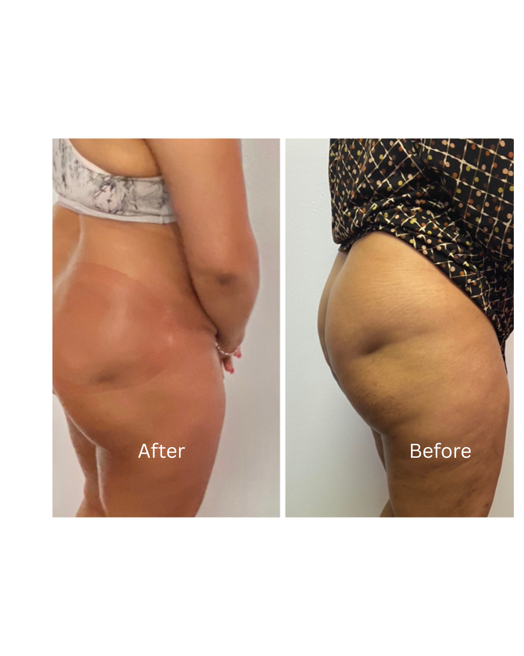 Cryo Cellulite (Series of 3)