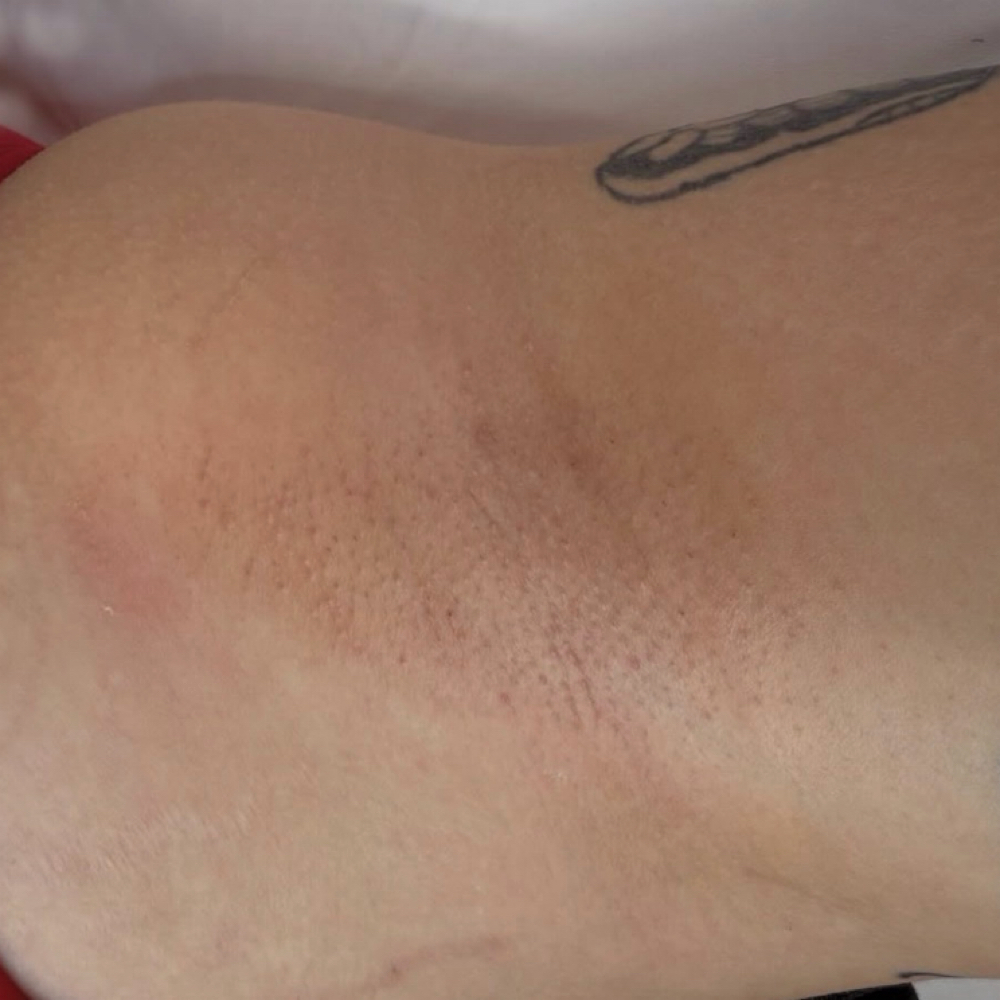 Under Arm Wax at Allure Esthetics in Kenosha, WI