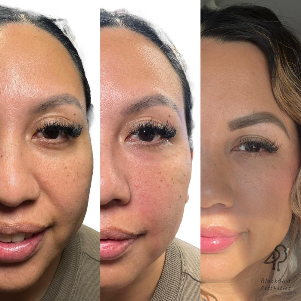 PRFM (Selphyl) Under Eye / Face at BlackBird Aesthetics in Fort Worth, TX