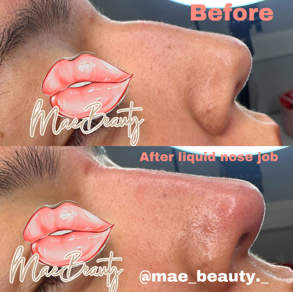 Non Surgical Rhynoplasty at MaeBeauty in Mesquite, TX