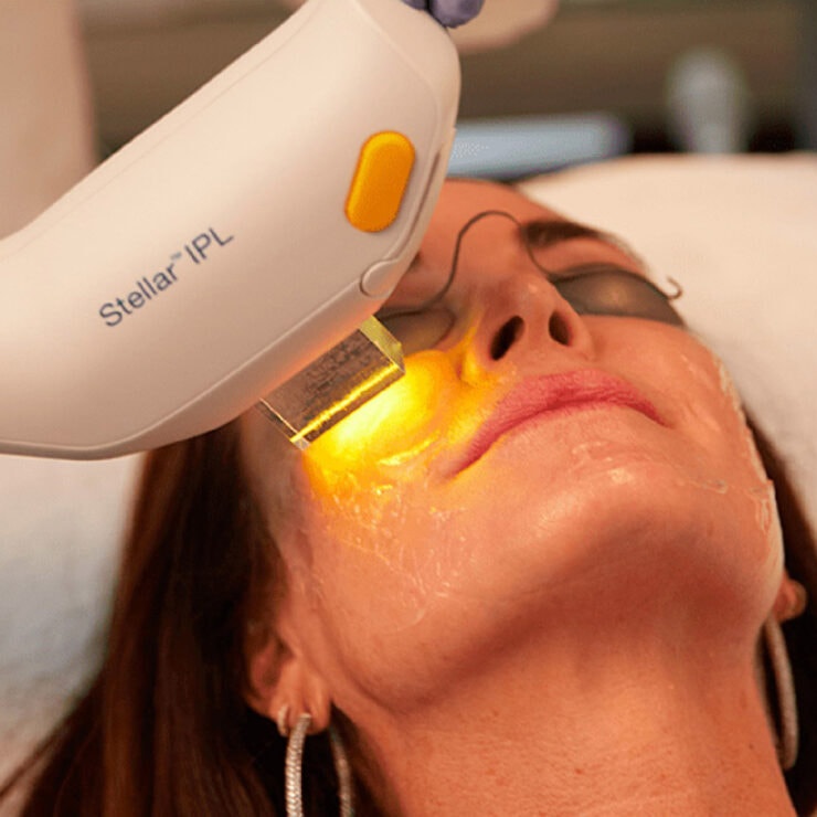 Photofacial treatment at Beleza Medspa in Denton, TX