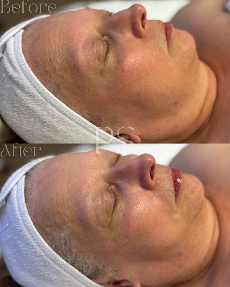 Level I Treatment - Refresh