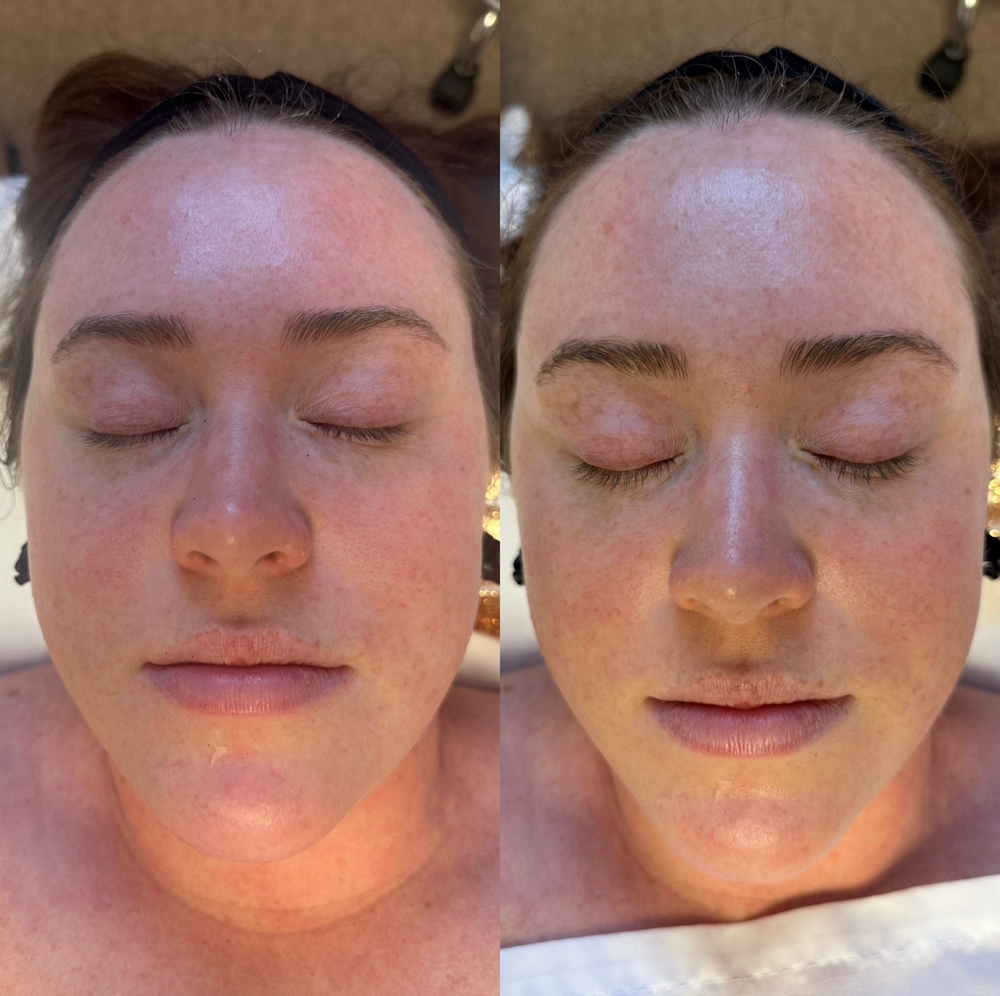 Level I Treatment - Refresh