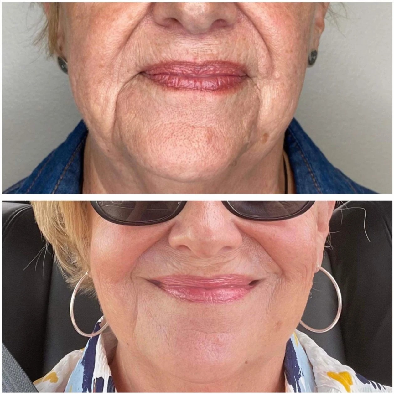 *Tixel face, eyes and neck at Marco Island Aesthetics