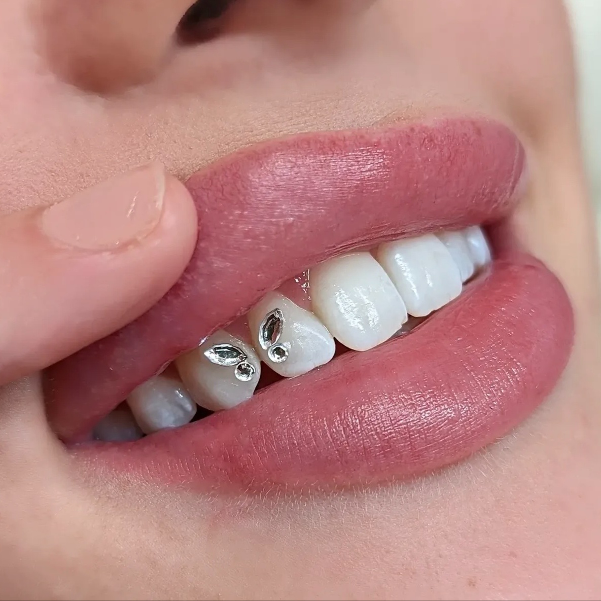 Butterfly Gems Design at Royal Blanc Smiles - Teeth Whitening and Tooth Gems in Charlotte, NC in Charlotte, NC