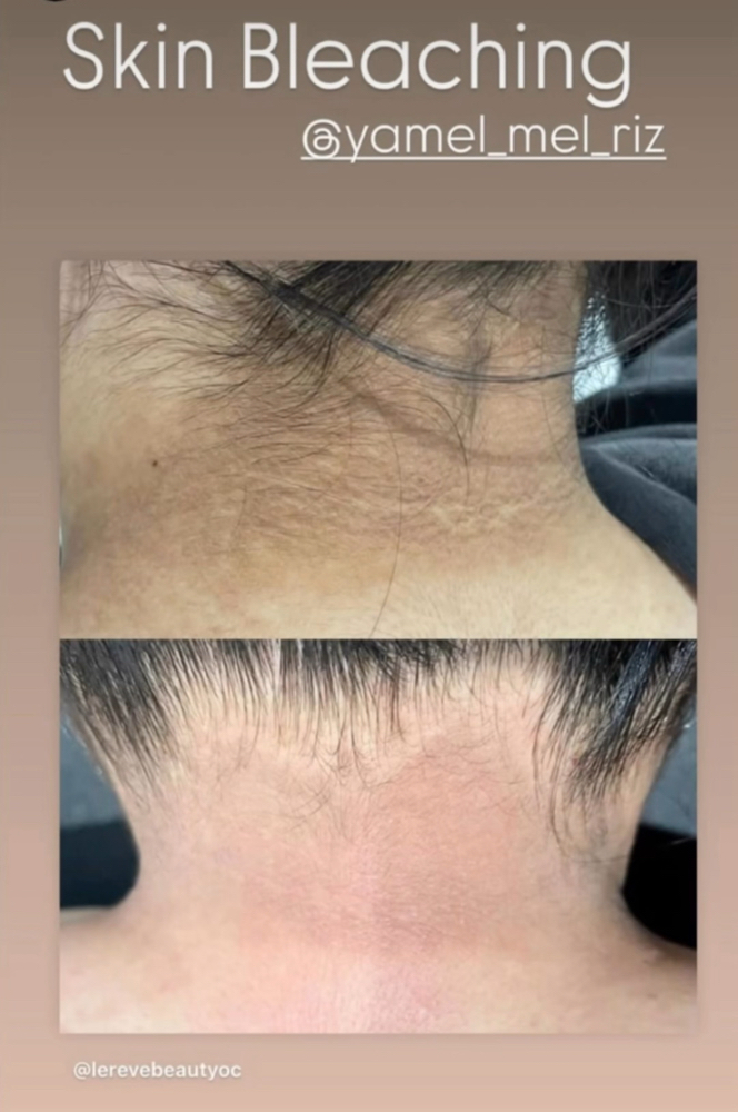 Skin Lightening & Brightening