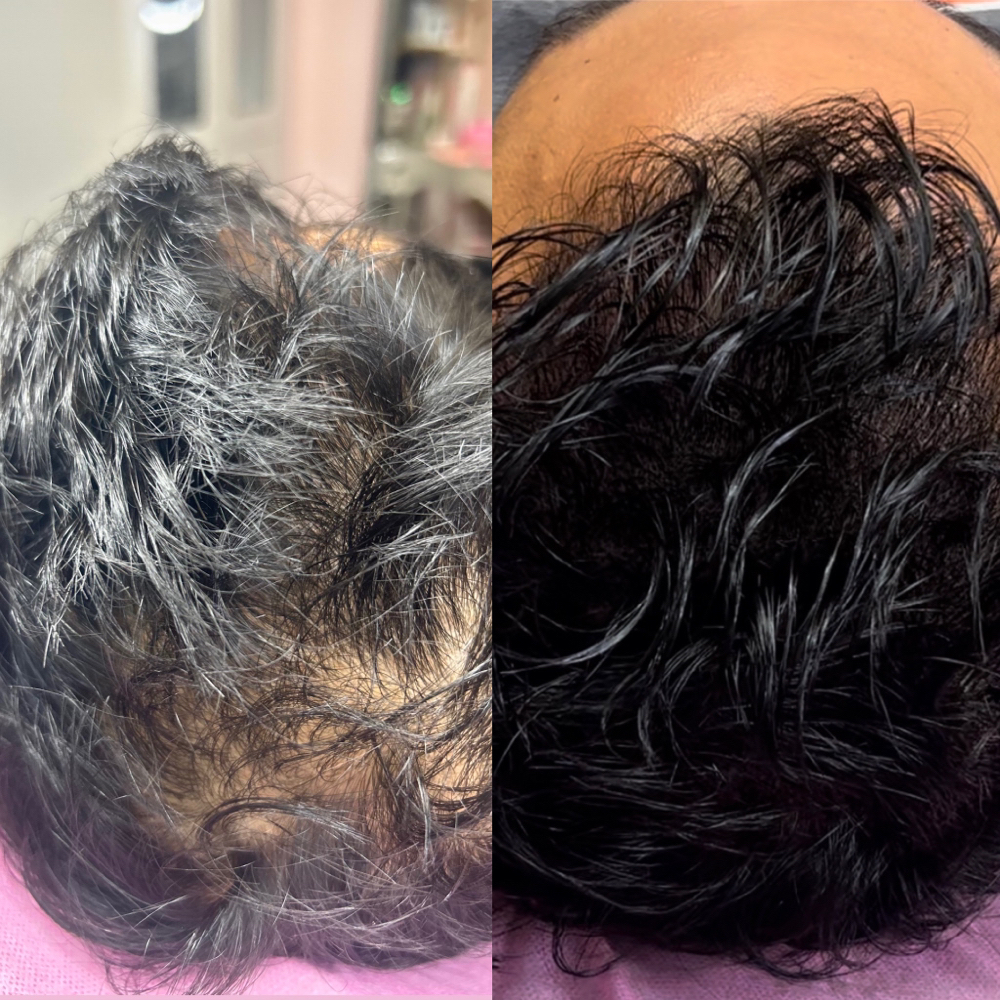 Scalp Micro-pigmentation