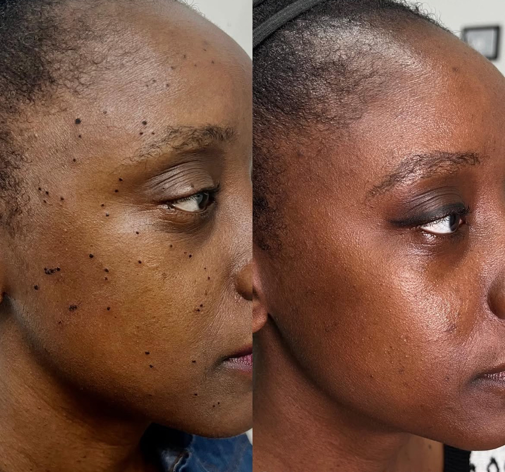 ( Mobile) DPN/Skin Tag/Mole Removal