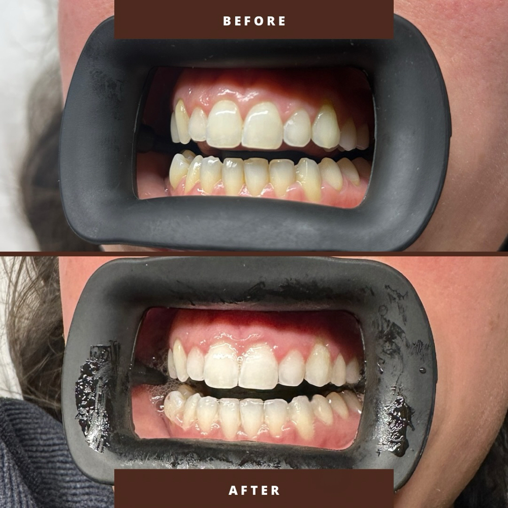 Cosmetic Teeth Whitening at Beautybyallie in Bastrop, LA