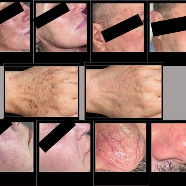 IPL Photofacial at The Skin Bar & Med Spa in Bryant, AR
