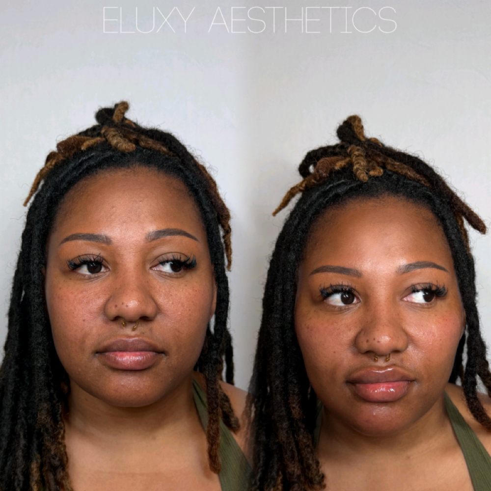 So Iconic Face Lift 4ML at Eluxy Aesthetics in Arlington, TX