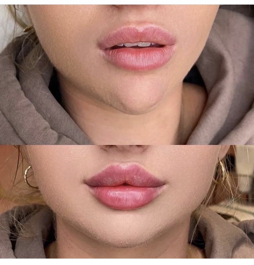 Lip Fillers