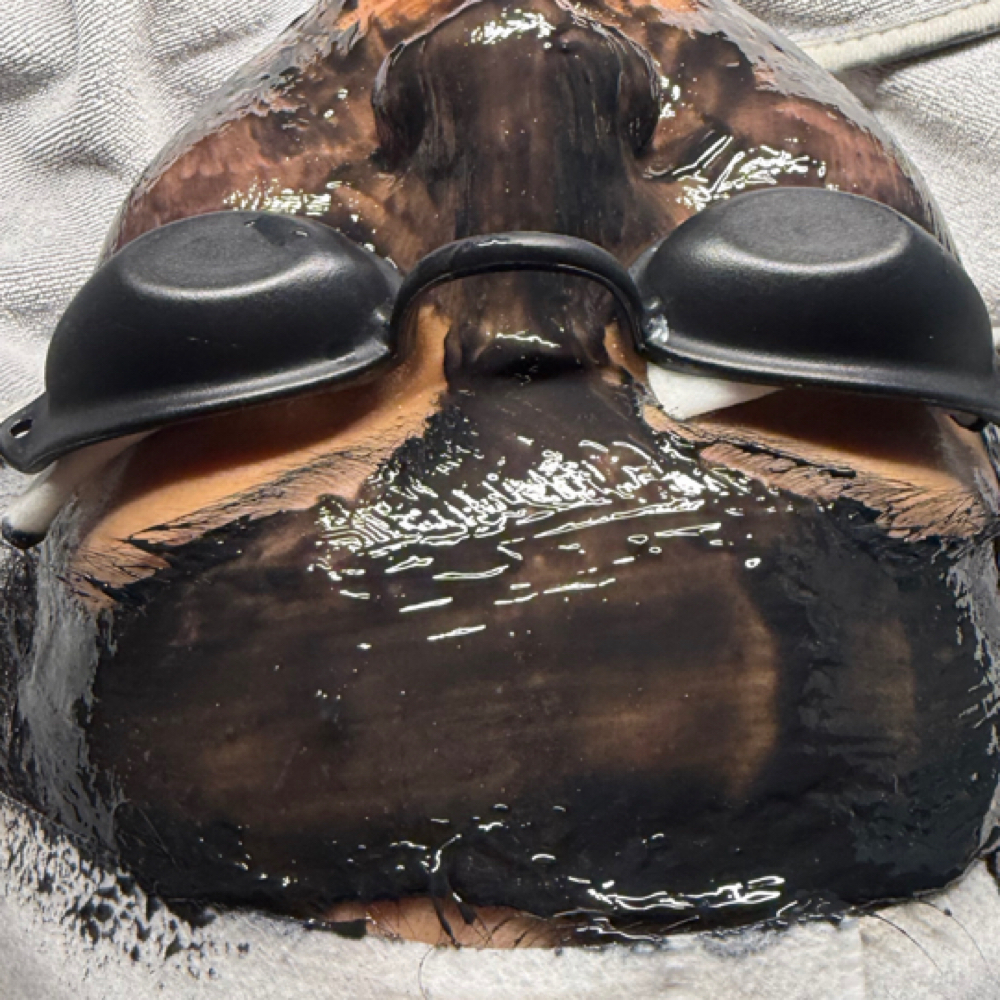 The”Advanced Acne Care” Treatment at Skinplicity Facial Spa in Jurupa Valley, CA