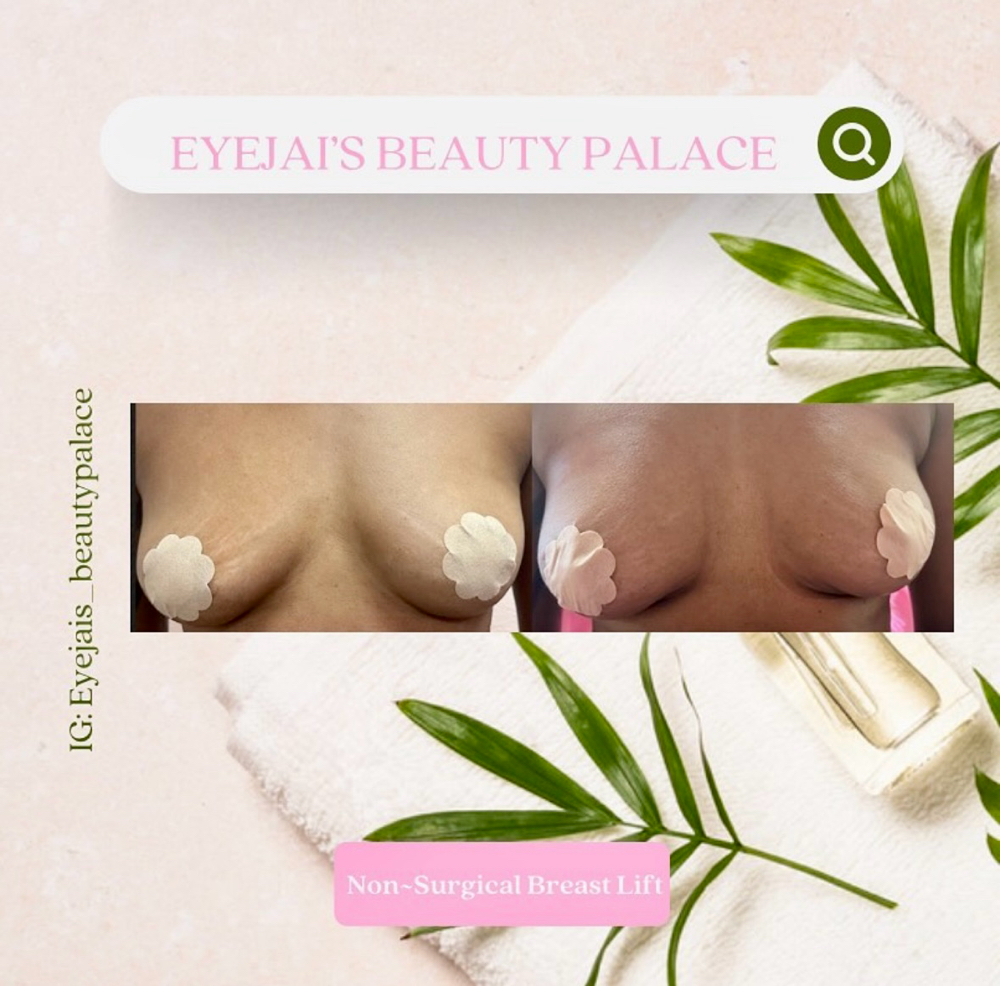 Breast Lift Enhancement