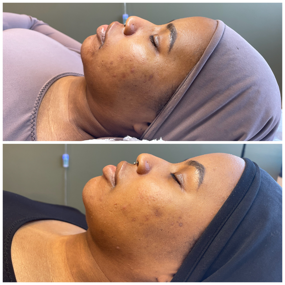 Microneedling at Lavish Lauren in Bala Cynwyd, PA