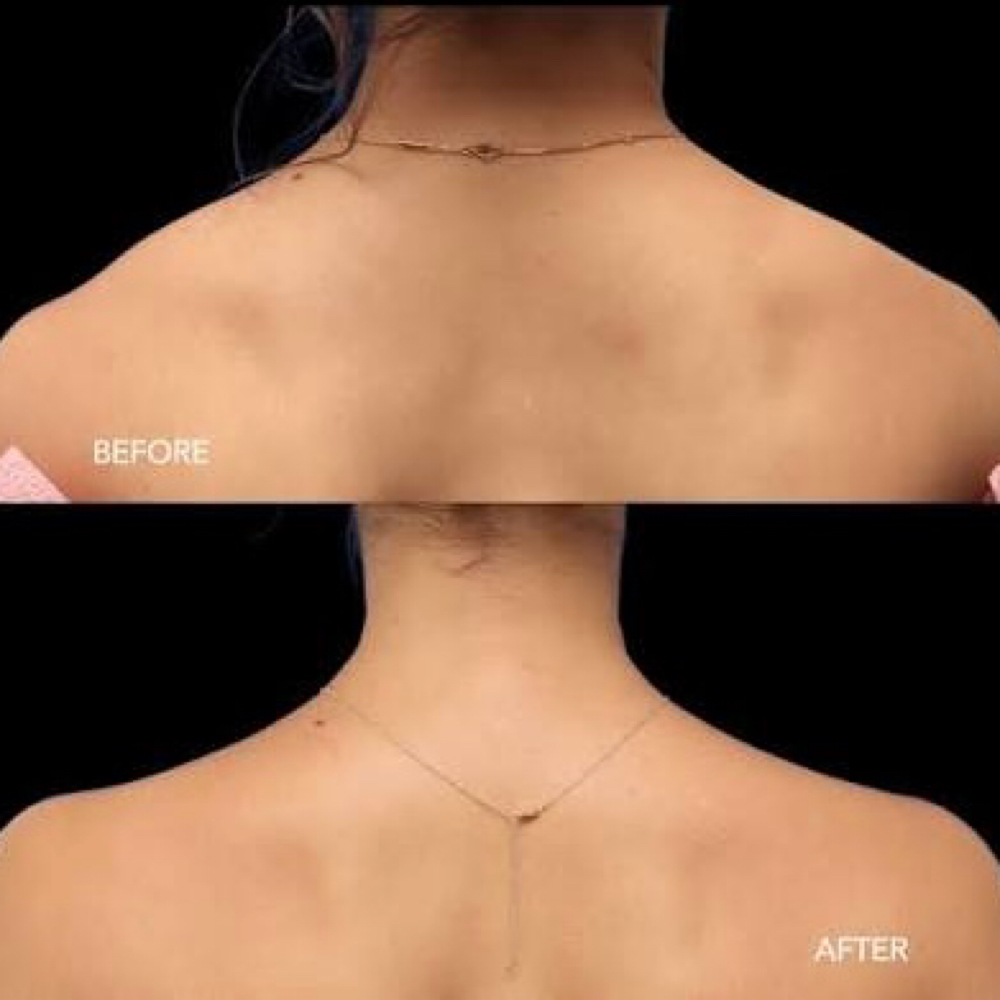 Trap Tox (Barbie Tox) at D' Beauty Studio LLC in Weslaco, TX