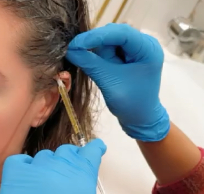 PRP Hair Restoration