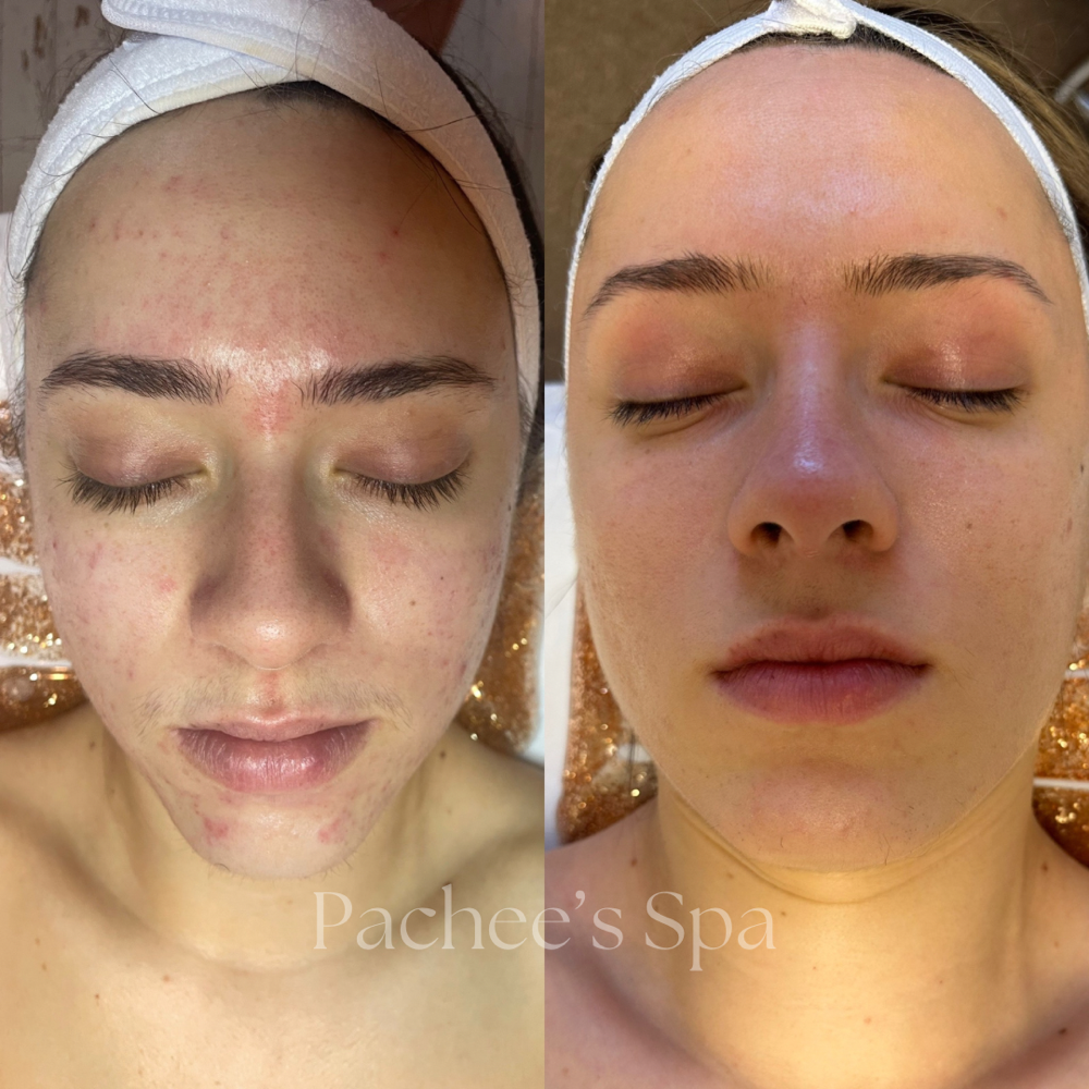 Customized Acne Facial