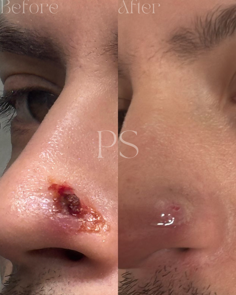 Customized Acne Facial