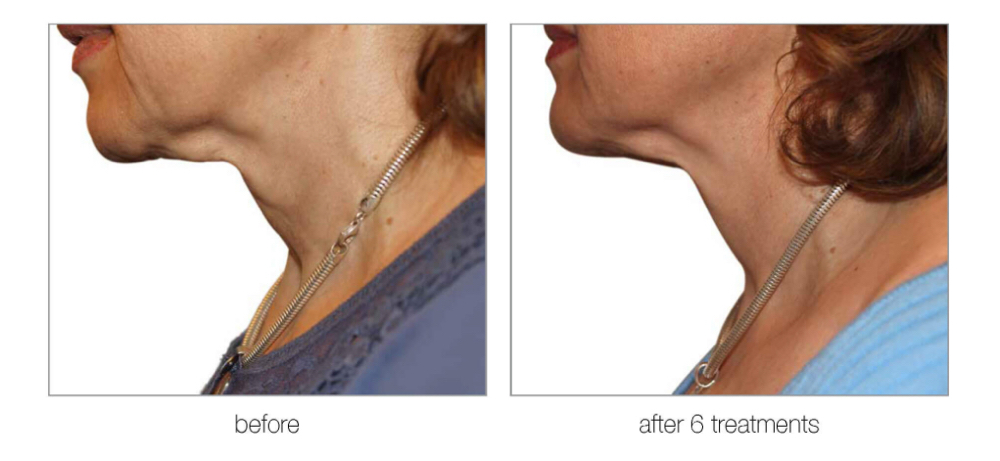 DiamondPolar™ RF Tighten at Effortless Esthetics LLC in Scottsdale, AZ