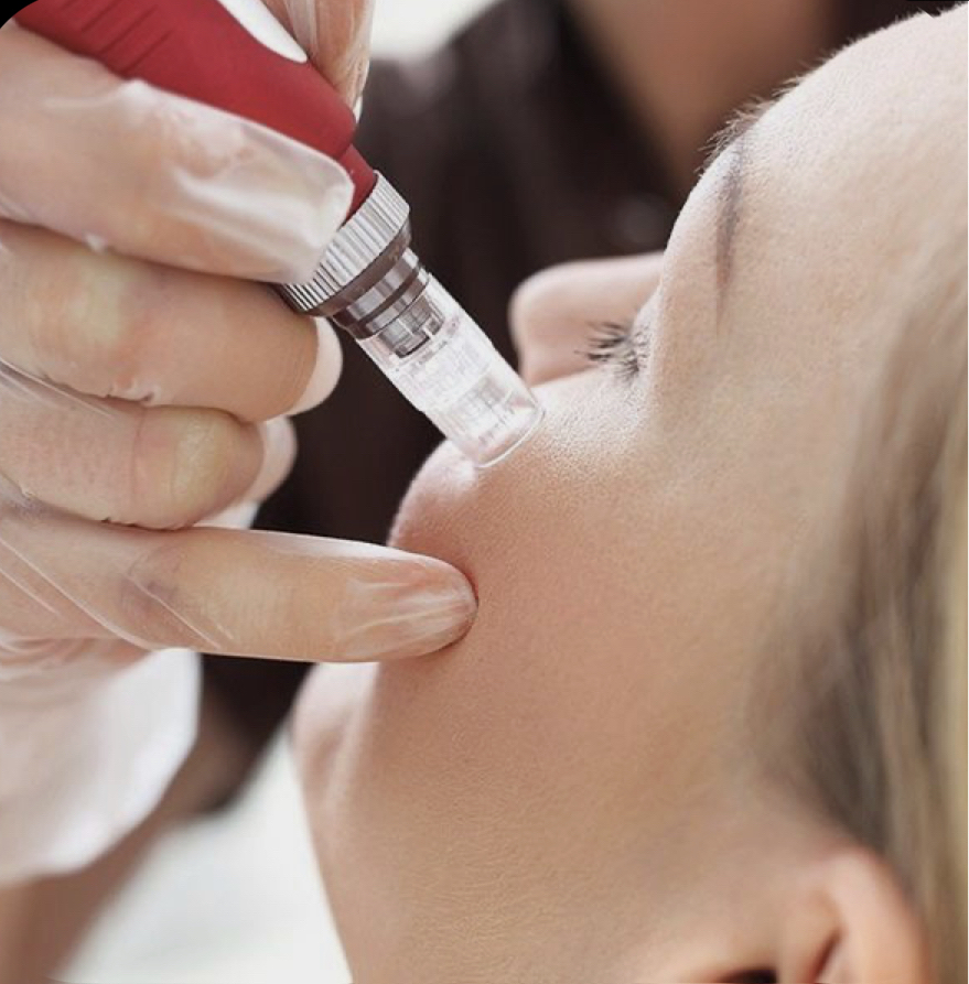 MICRONEEDLING TREATMENT