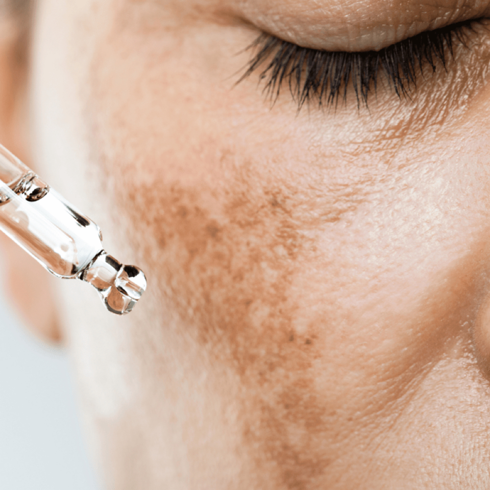 Melasma Treatment Facial at Luxe Glow Esthetics LLC in South Carolina, SC