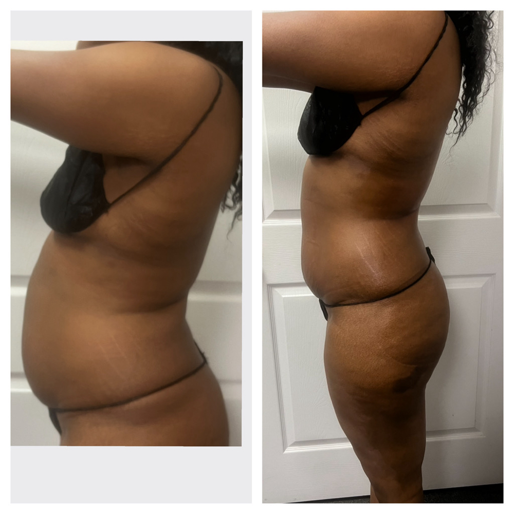 Laser Lipo