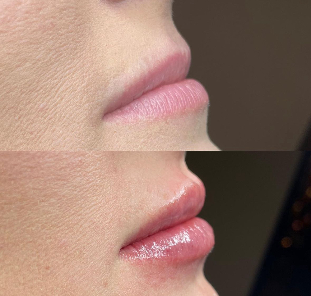 Lip Filler 1ML