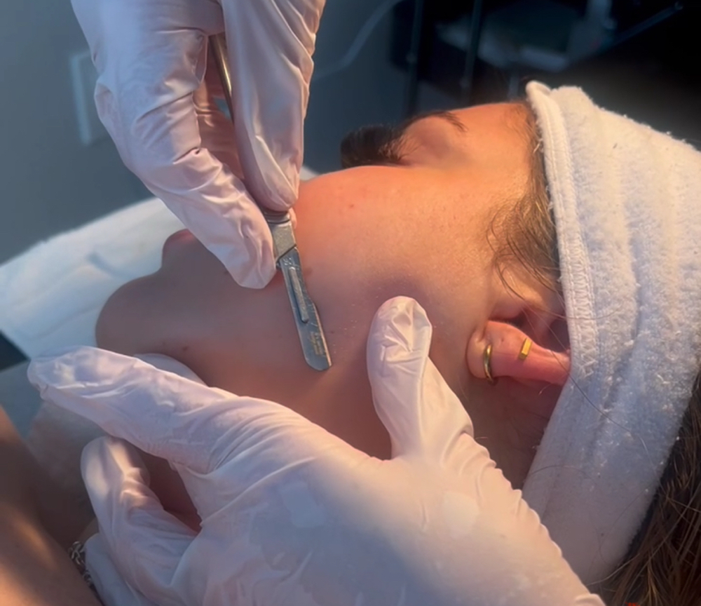 Dermaplane Facial