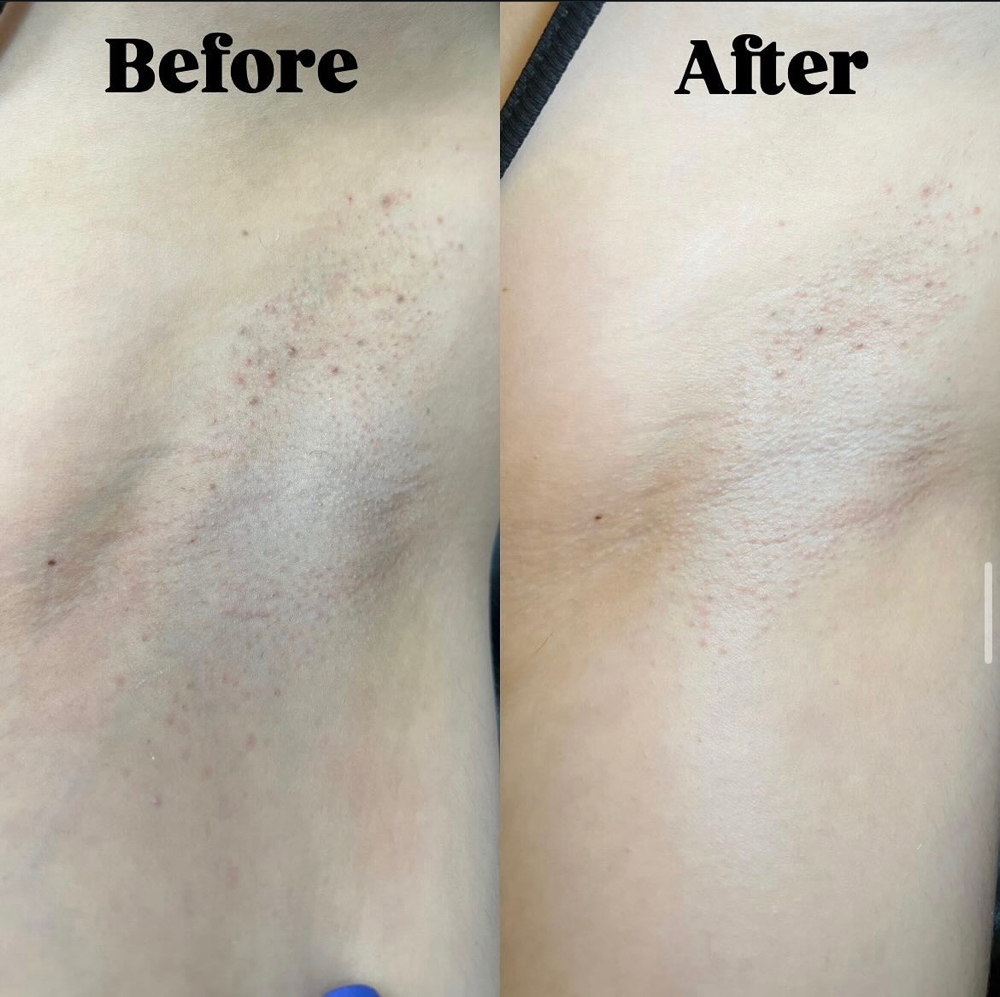 Underarm Lightening Treatment