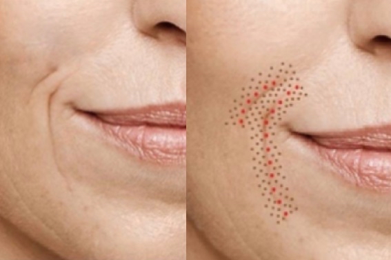 Nasolabia/Smile Lines