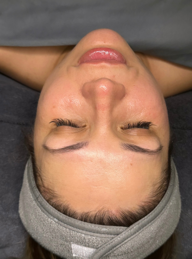 No Botox Facial