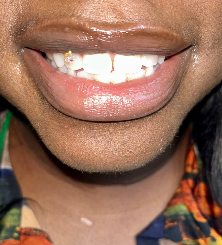 Tooth Whitening w/ 2 Gems