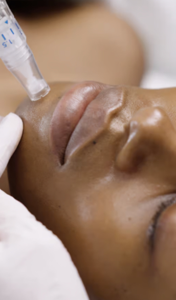 Microneedling