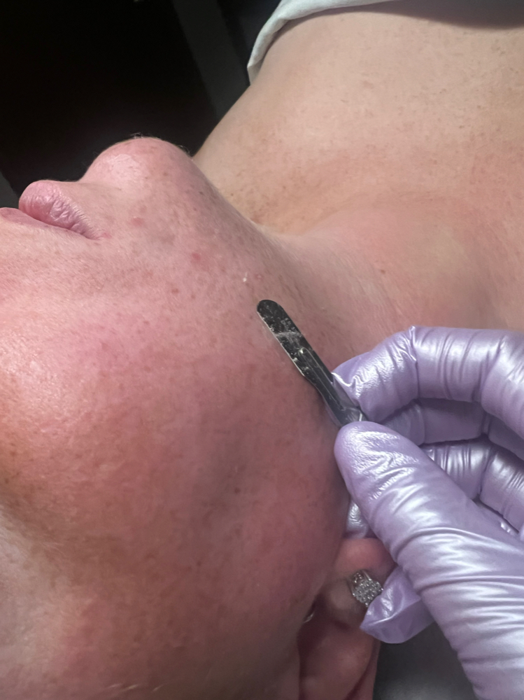 Express Dermaplane