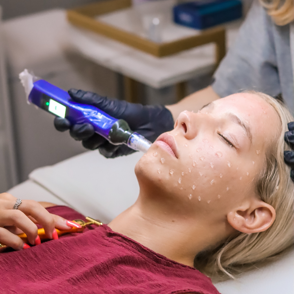 SkinPen® Microneedling