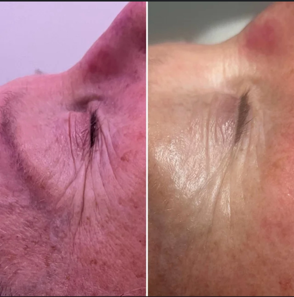 Beyond Botox Facial