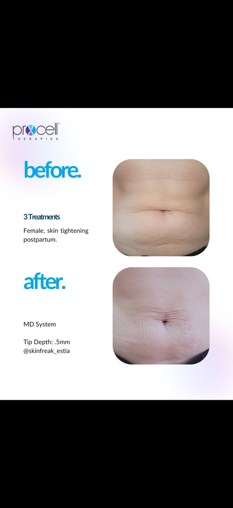 Microchanneling Body Treatment