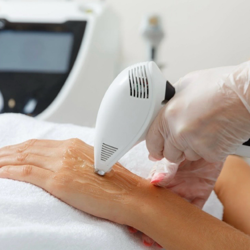IPL Hands at Olivia Esthetics in Longview, TX