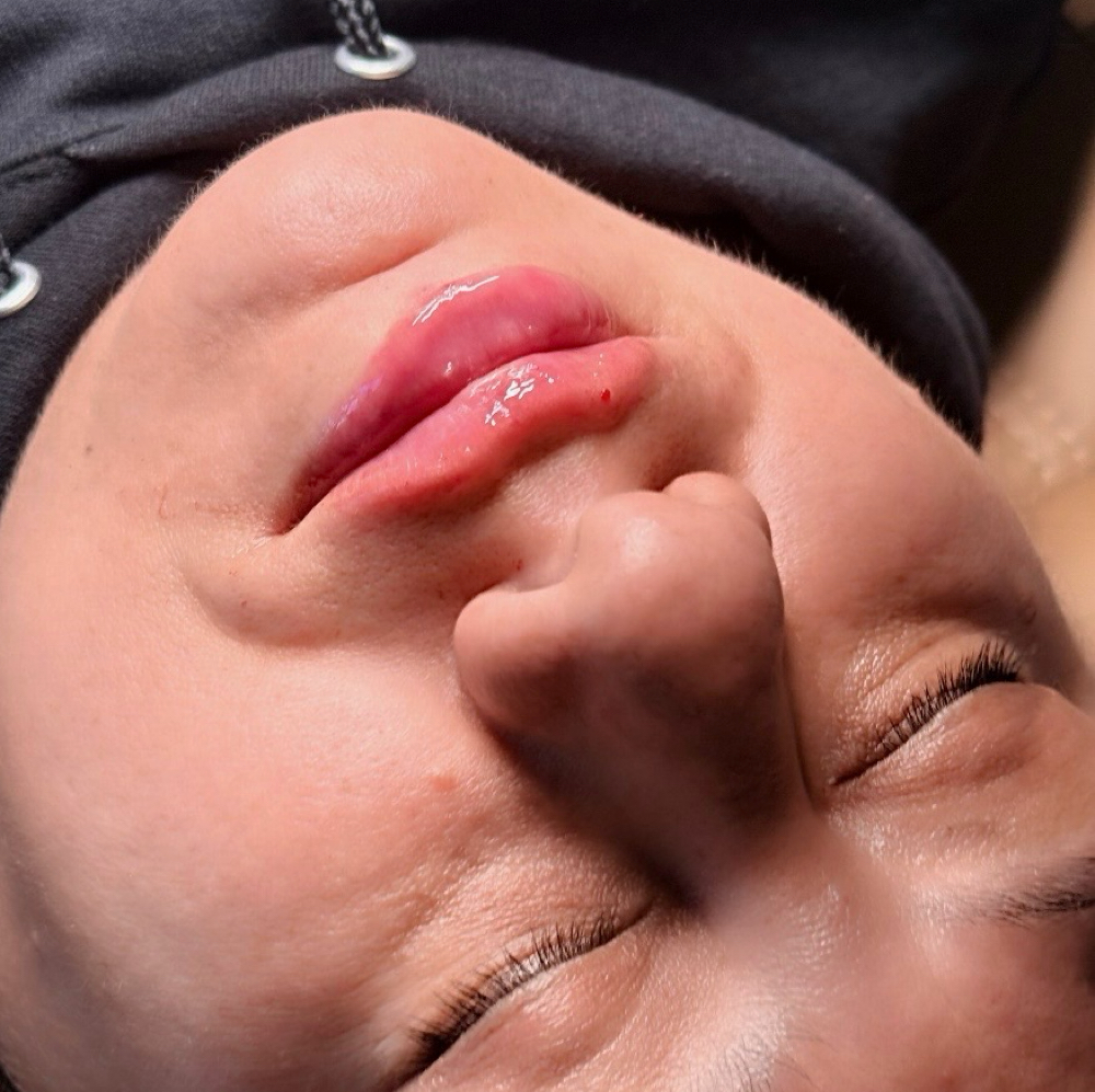 Russian Lip at GlowJect in Amarillo, TX