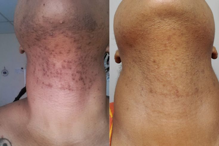 Neck- Laser Hair Removal