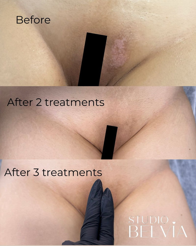 Intimate Skin Lightning