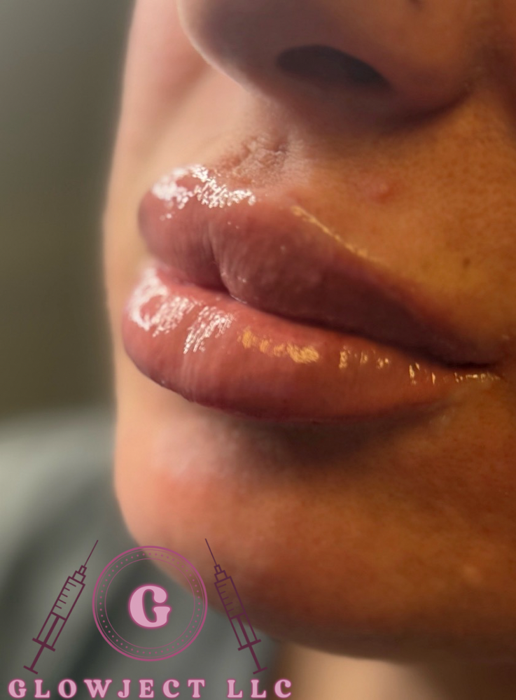 1 Full Syringe Of Lip Filler