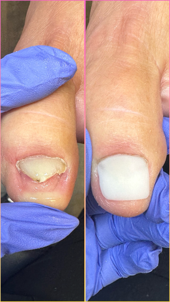 Toenail Reconstruction • NEW Client