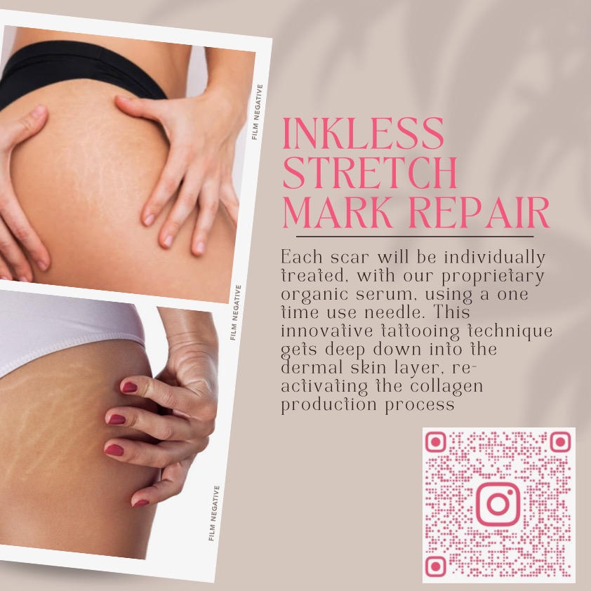 Inkless Tummy Tuck Scar  Repair