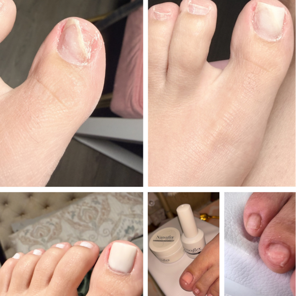 Toe Nail Reconstruction at Rodriann Fuentes Nail Studio, LLC in Weeki Wachee, FL