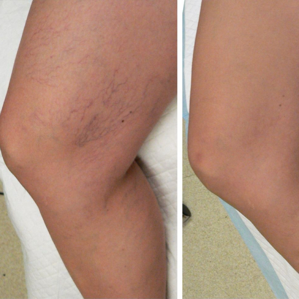 LUMECCA BLOOD VESSELS at Lavana by Remake in Edinburg, TX