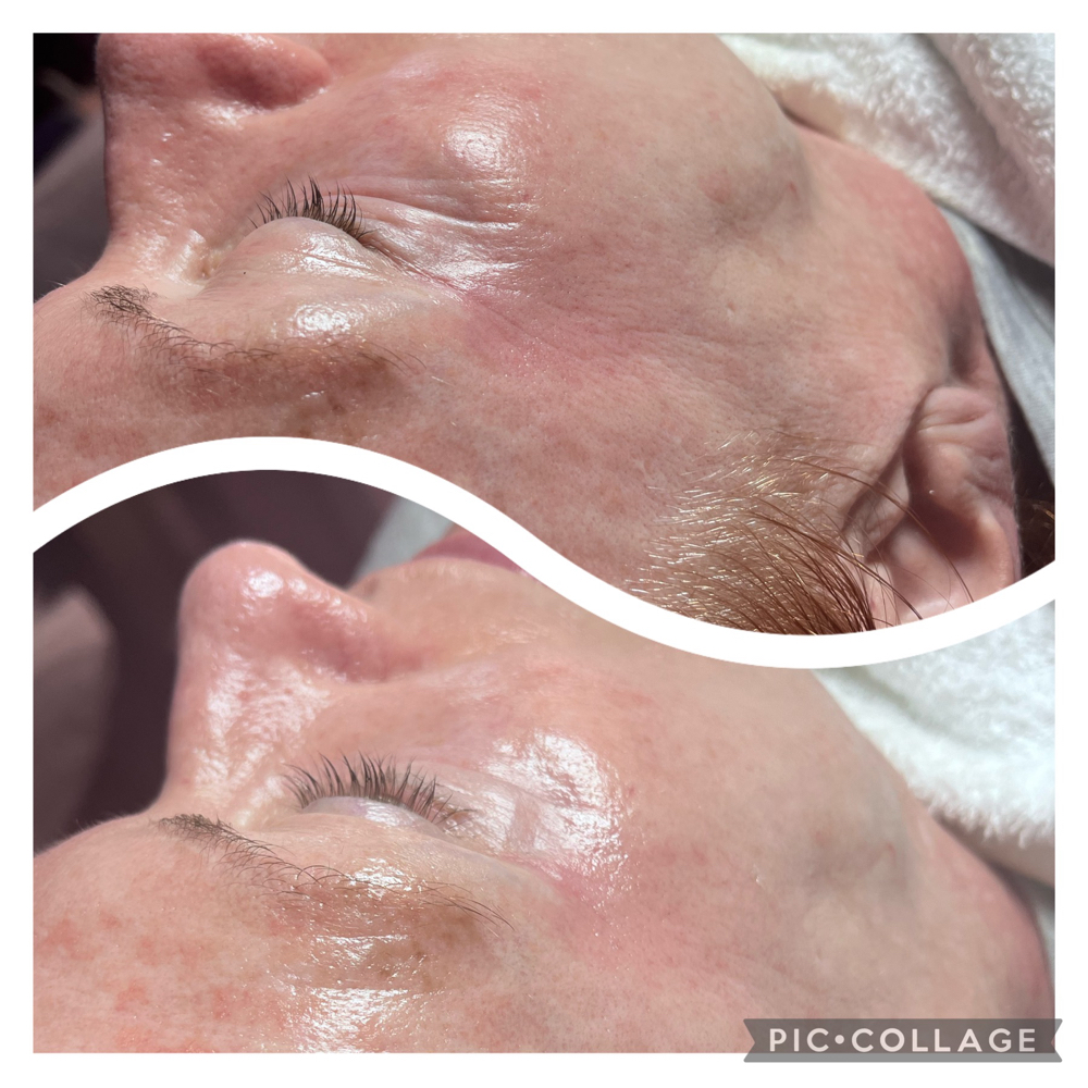 Anti-Wrinkle Facial Treatment