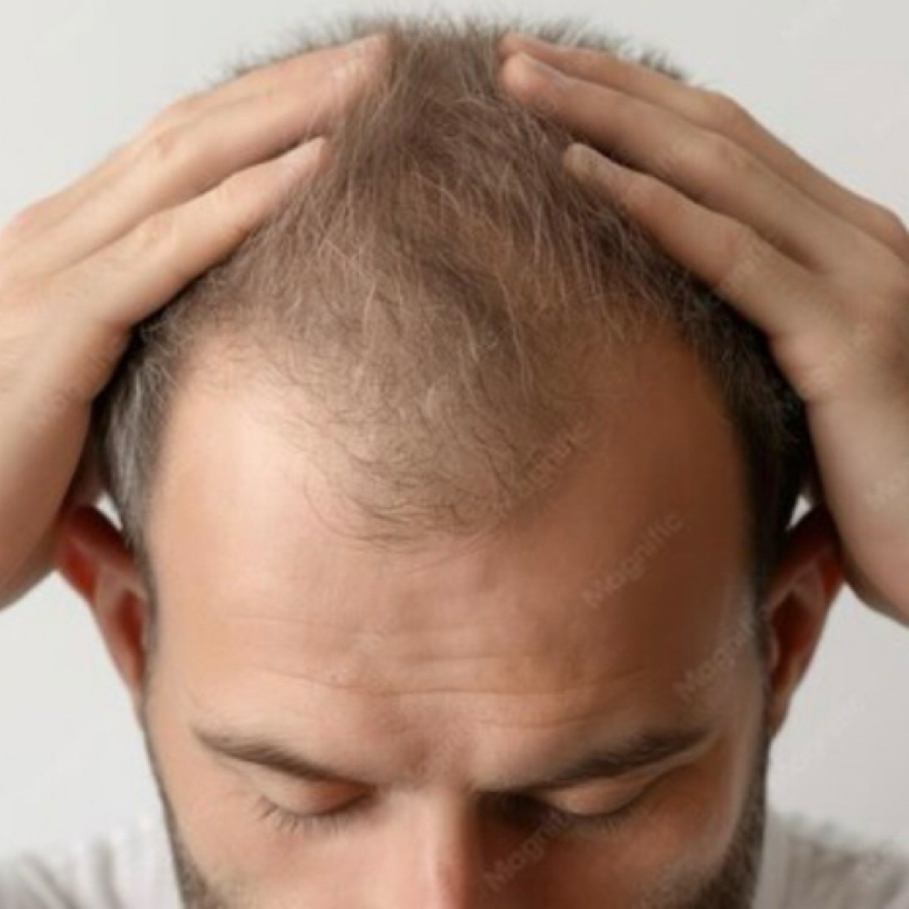 Half Scalp I 6 Sessions at EverBeauty Laser & Aesthetics in Argyle, TX